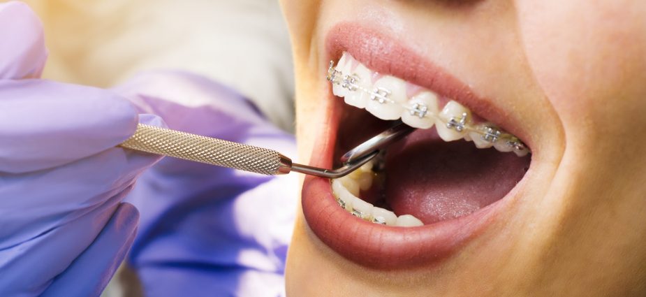 Got Braces?  Family dentistry, Teeth braces, Dentistry