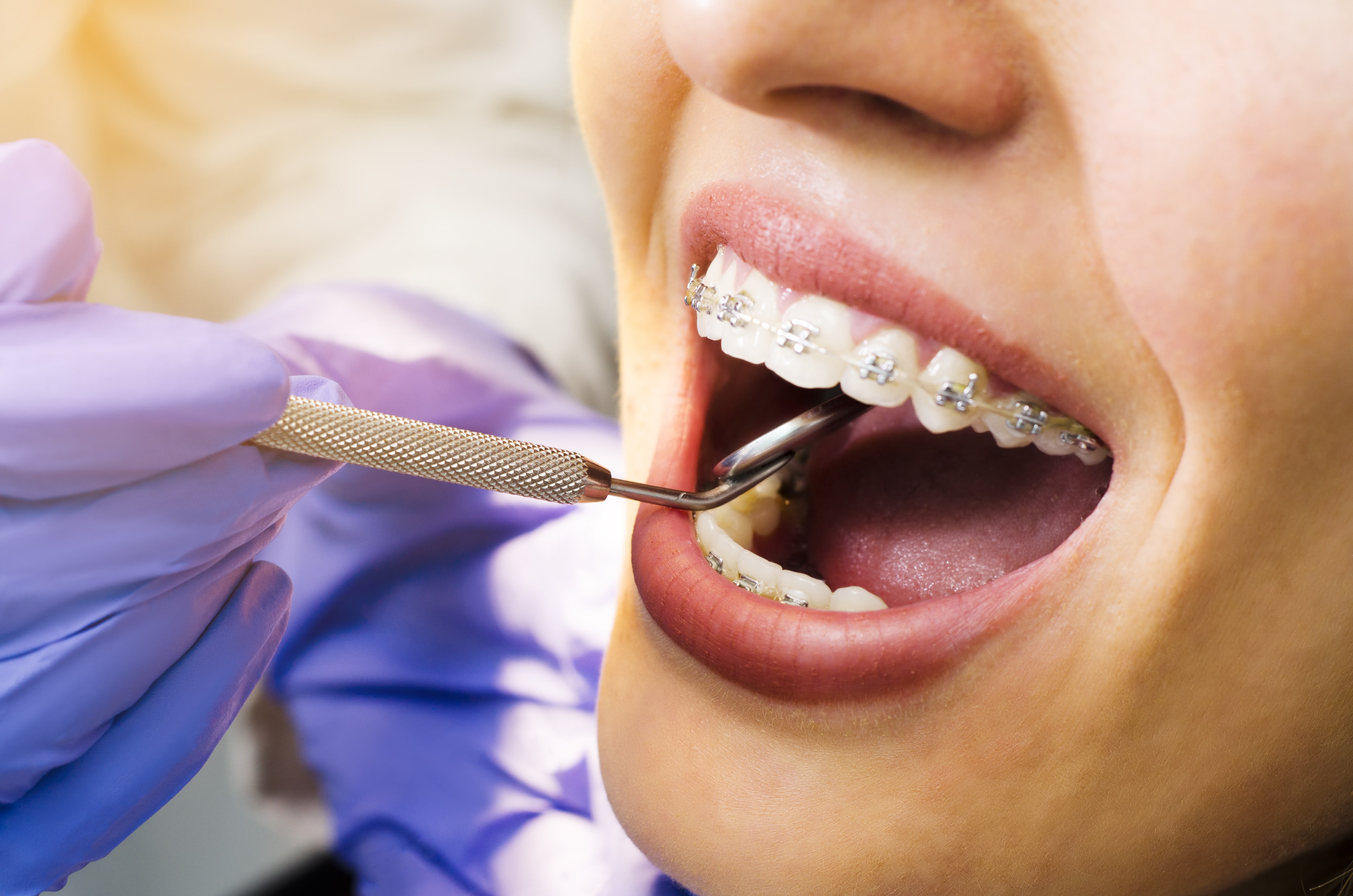 Dental Braces Treatment Details