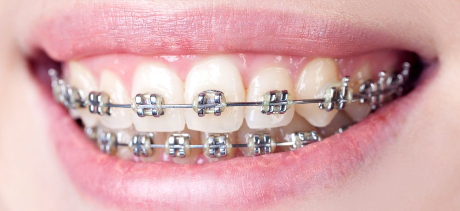 Are Adult Braces Effective? - McDonald Orthodontics