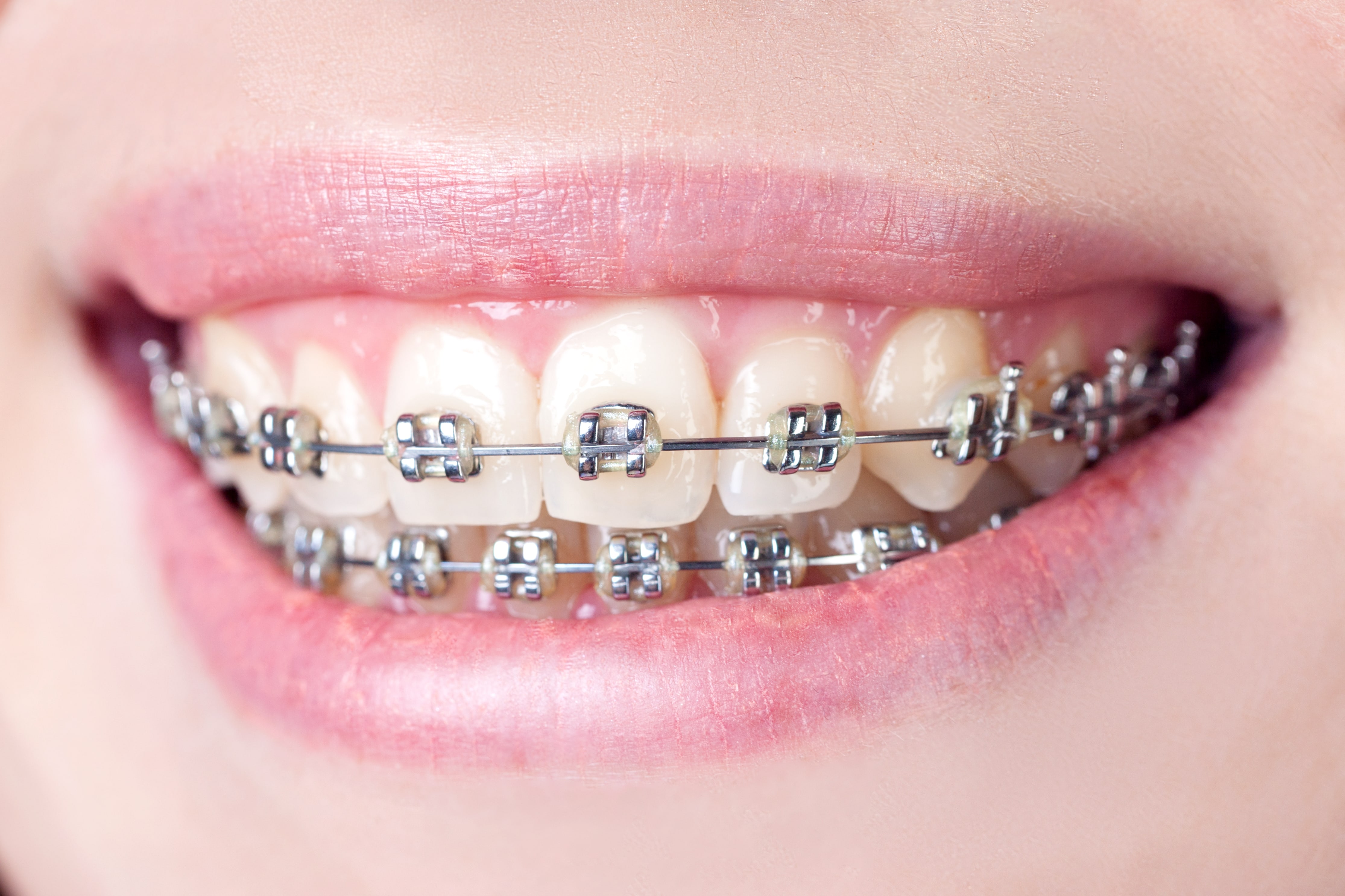 See How Invisalign Compares to Traditional Metal Braces