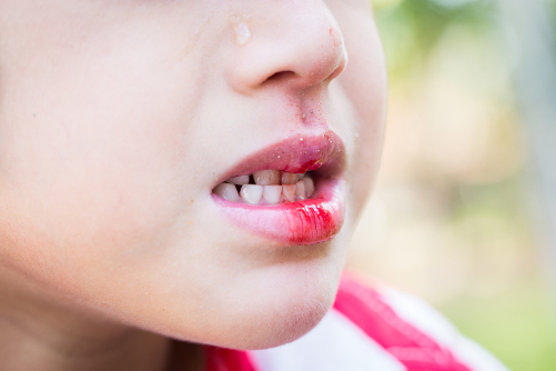 7 Reasons You Keep Getting Canker Sores Consumer Guide To Dentistry