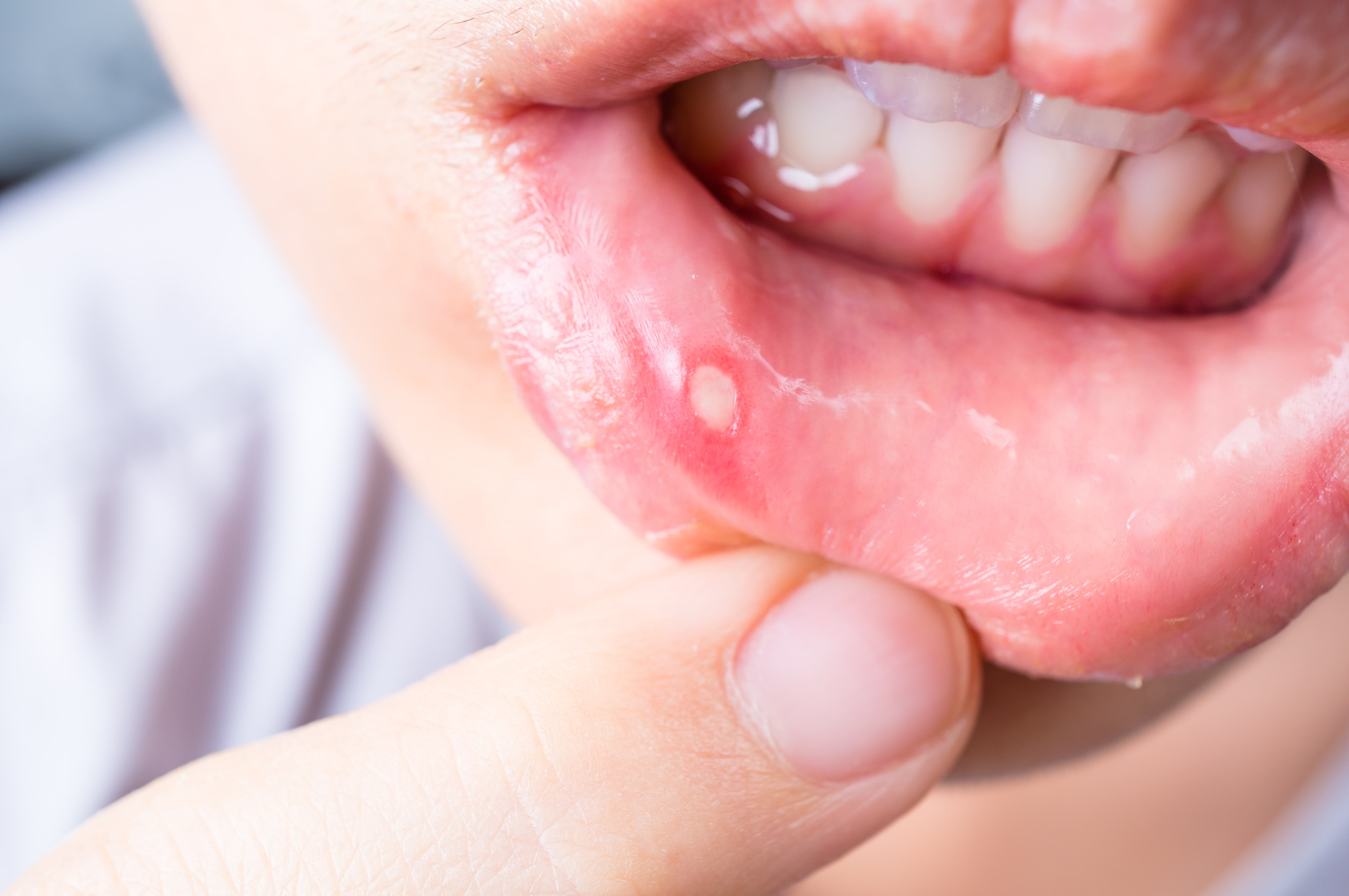 7 Home Remedies For Canker Sores Consumer Guide To Dentistry