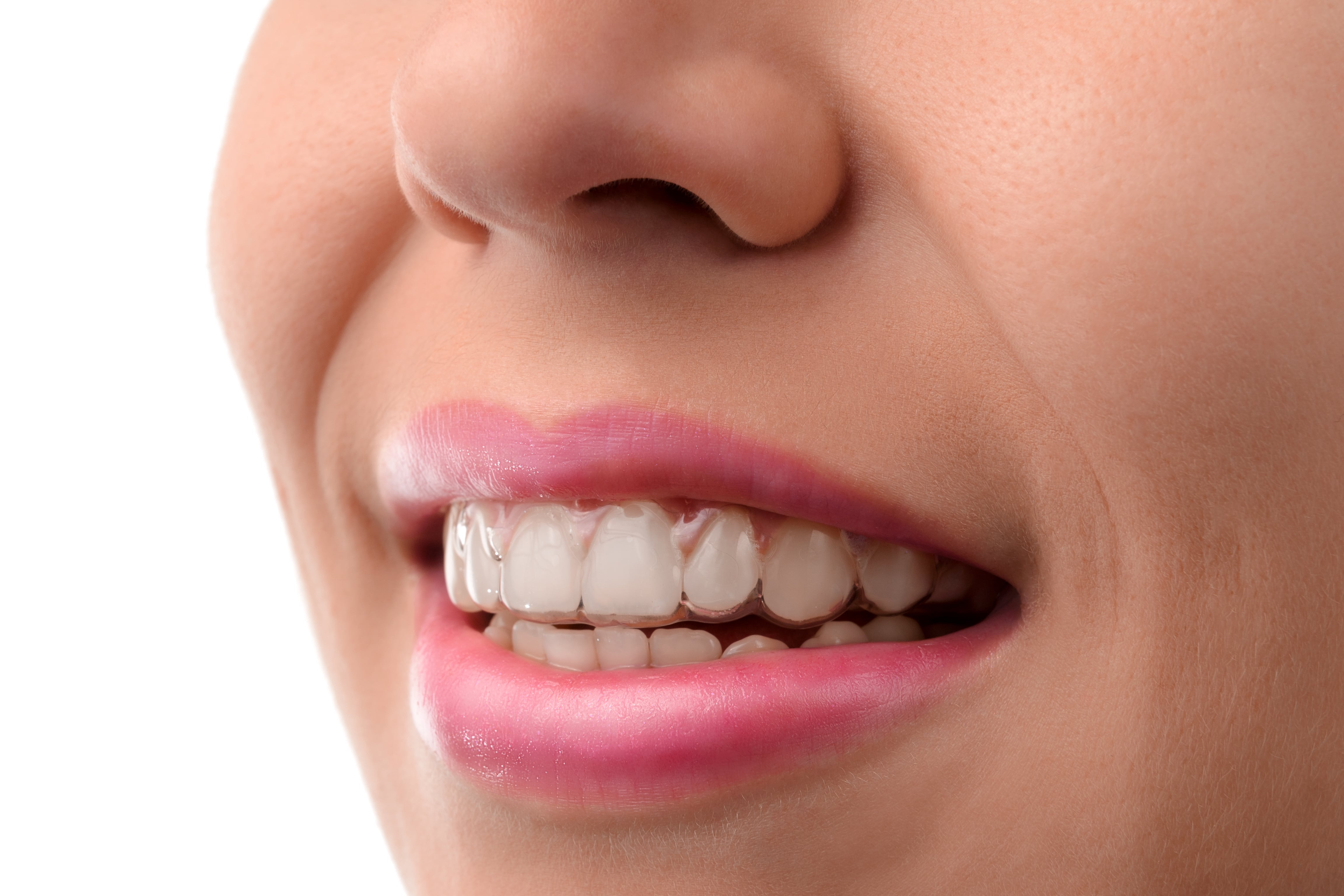 Invisalign Express & Teen | A Better Orthodontic Option?