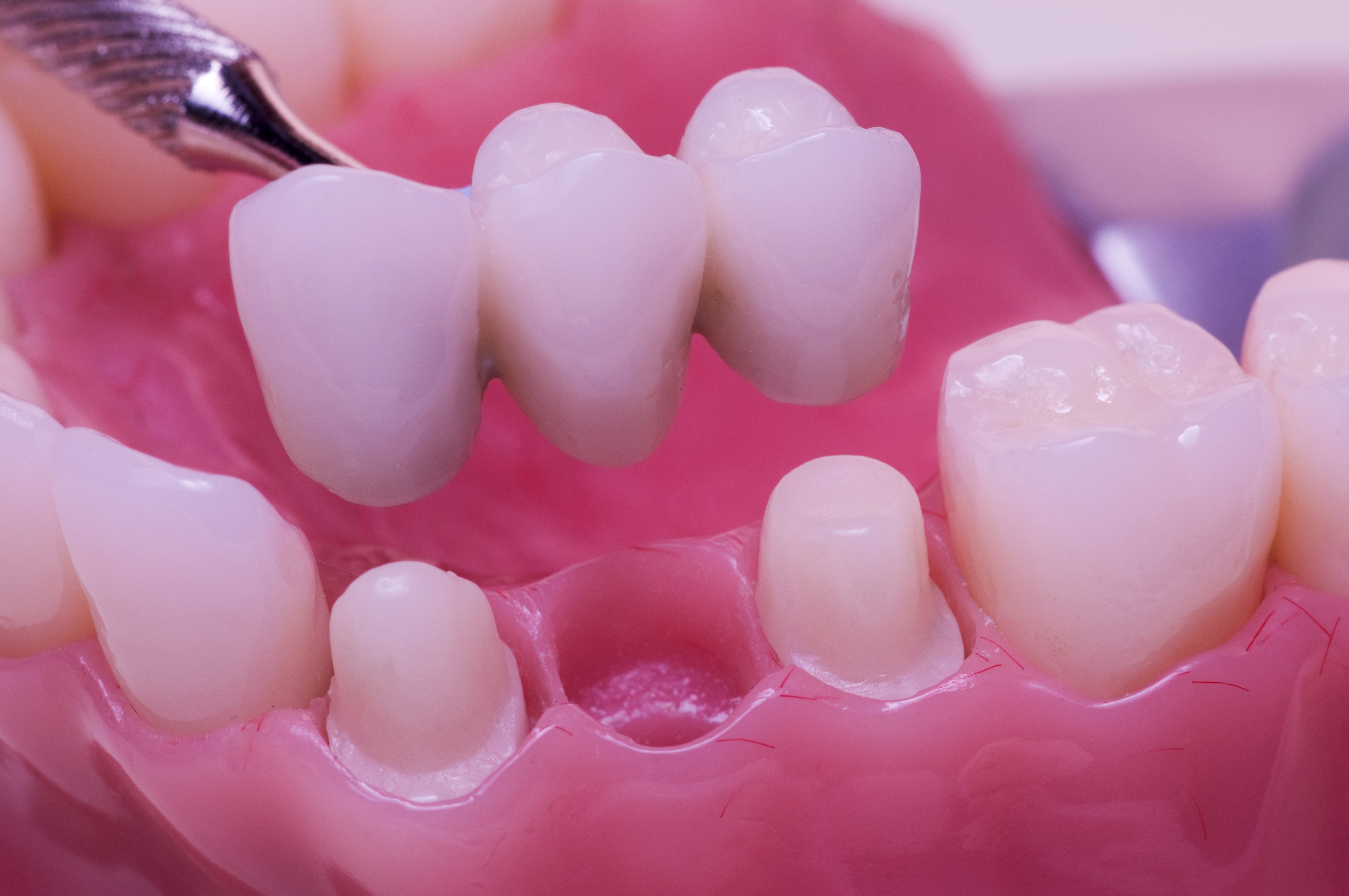 Dental Bridges How They Work What They Cost 