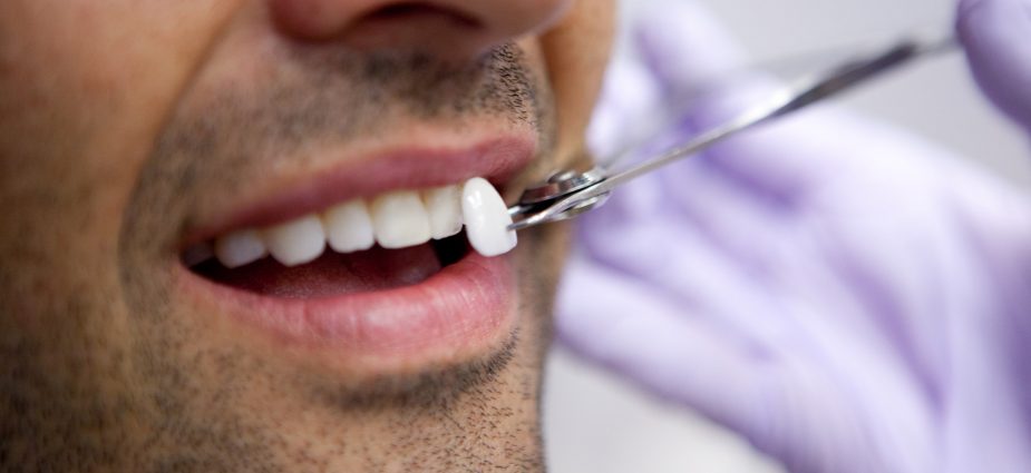 Carillas dentales: ¿Qué pueden hacer por mi sonrisa?