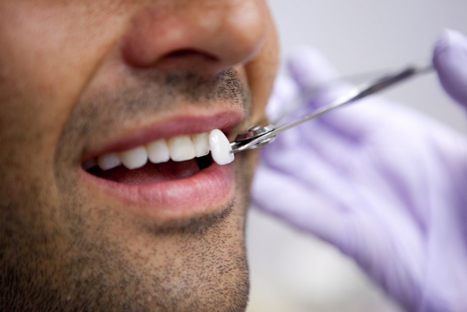 Carillas Dentales de Porcelana  Tratamiento, Recuperación y Costo