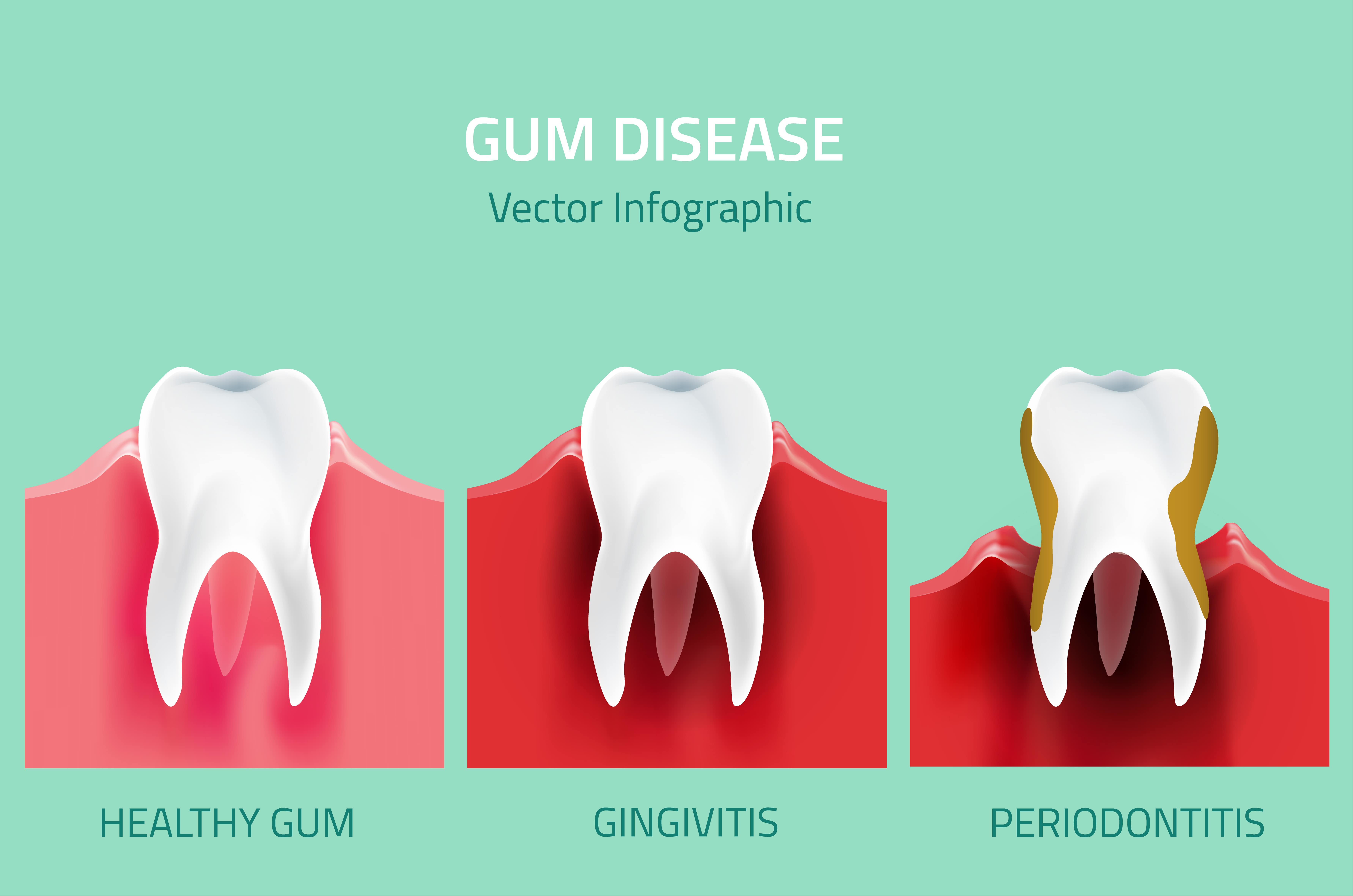 Gum Disease Signs Symptoms Treatment Options