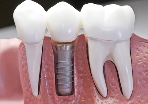 Dental Implants Saratoga Springs Ny