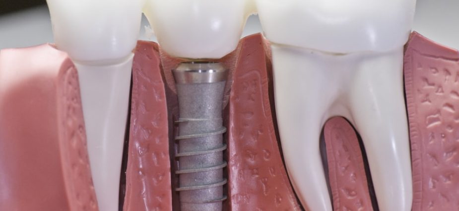 model showing a comparison between natural teeth roots and a dental implant above and below the gumline