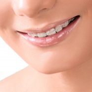 Dental Braces Treatment Details | Removal & Recovery