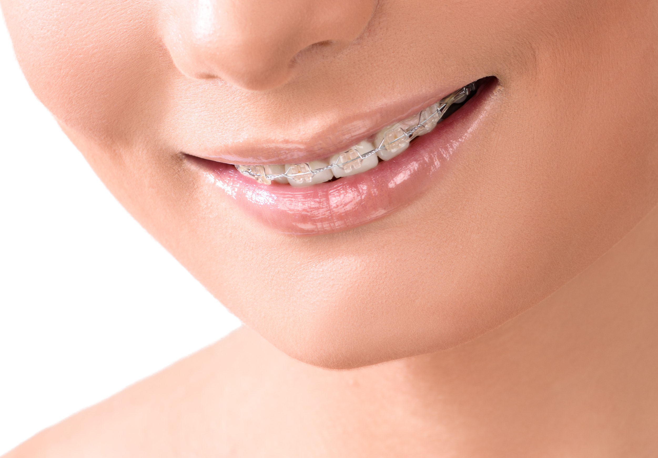 Invisible Braces, Visible Results: Why Invisalign® is the Clear