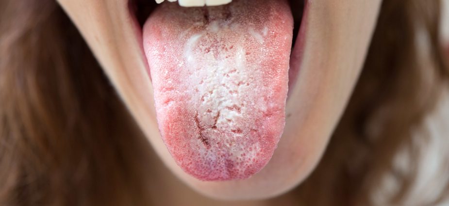 Oral Thrush  Causes, Symptoms, Risk Factors & Treatment