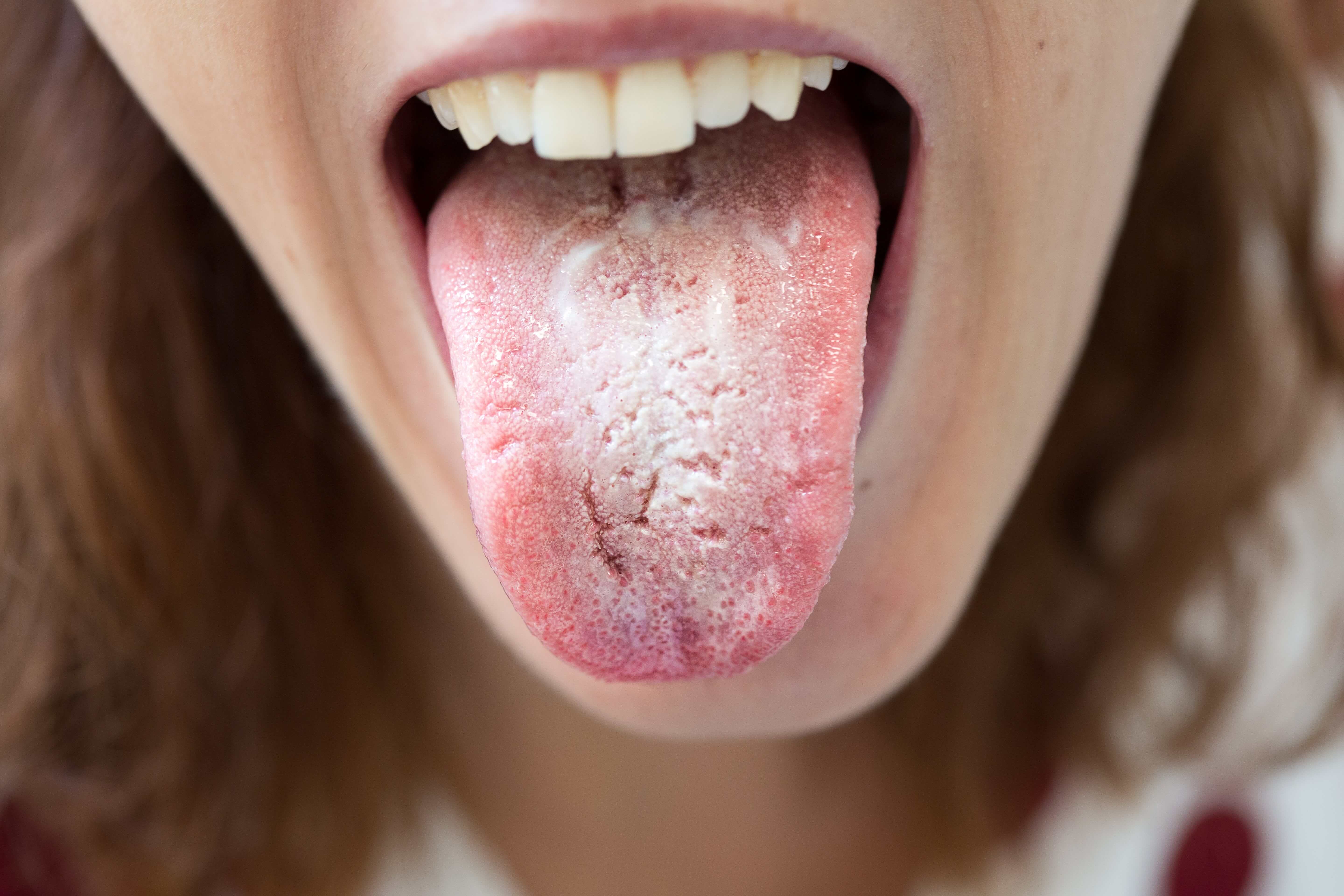 thrush infection in mouth