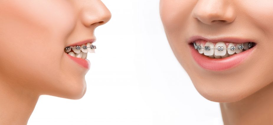 About Us  Brace Align Orthodontic & Dental Clinic