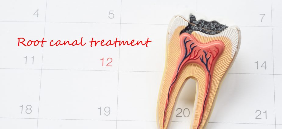 illustration of a tooth requiring root canal treatment sitting on a calendar