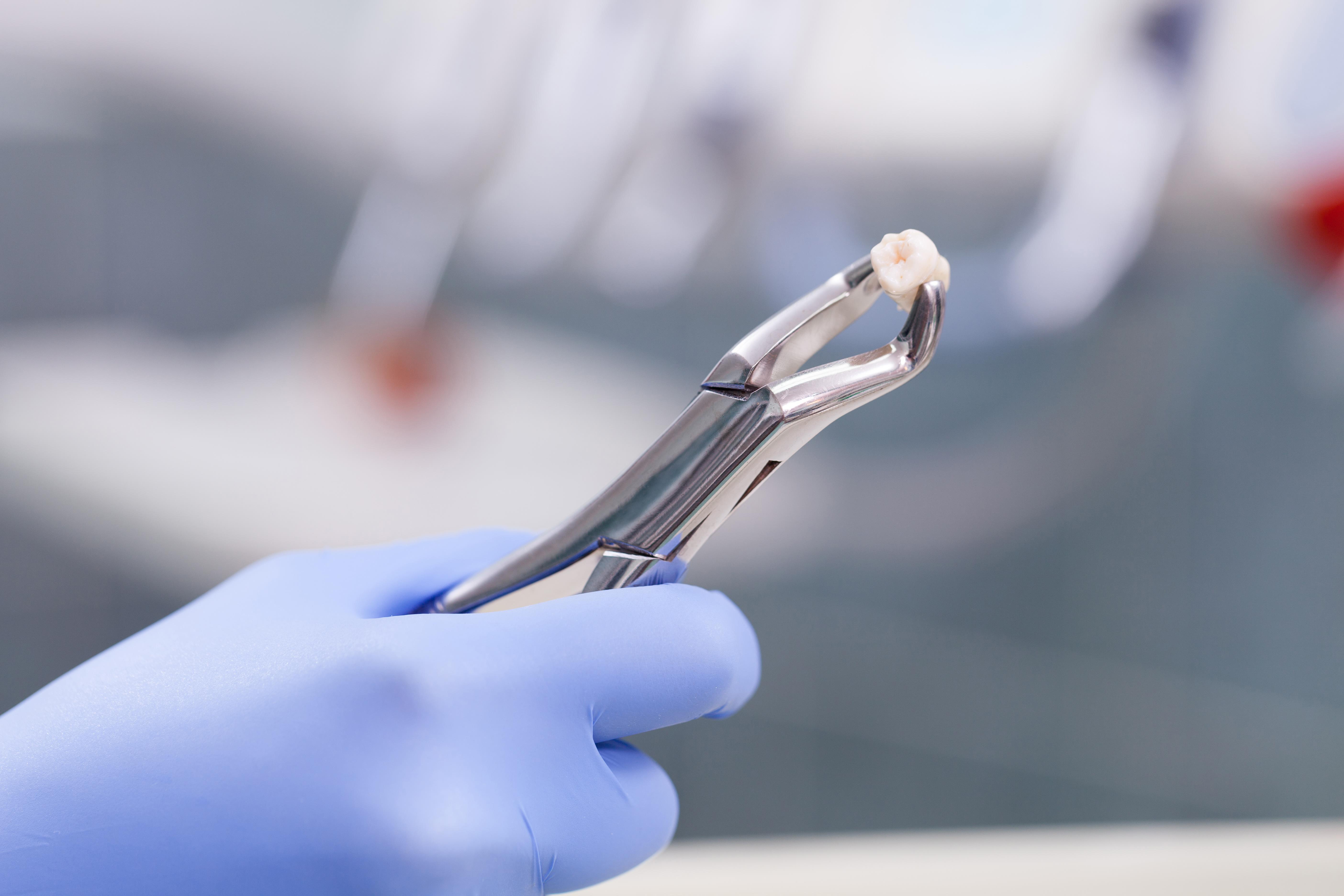 Tooth Extraction Expectations Complications Cost Aftercare