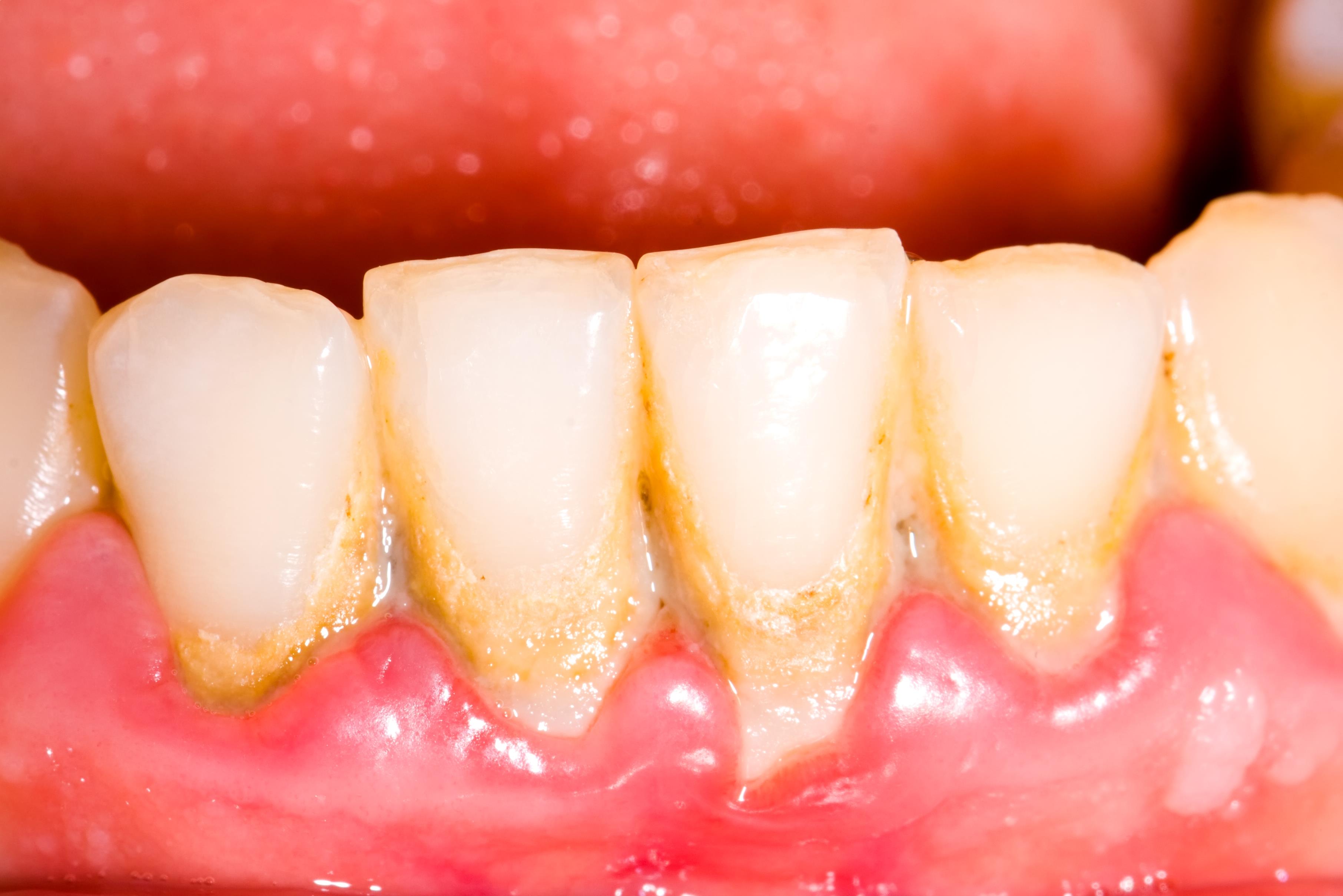 plaque teeth