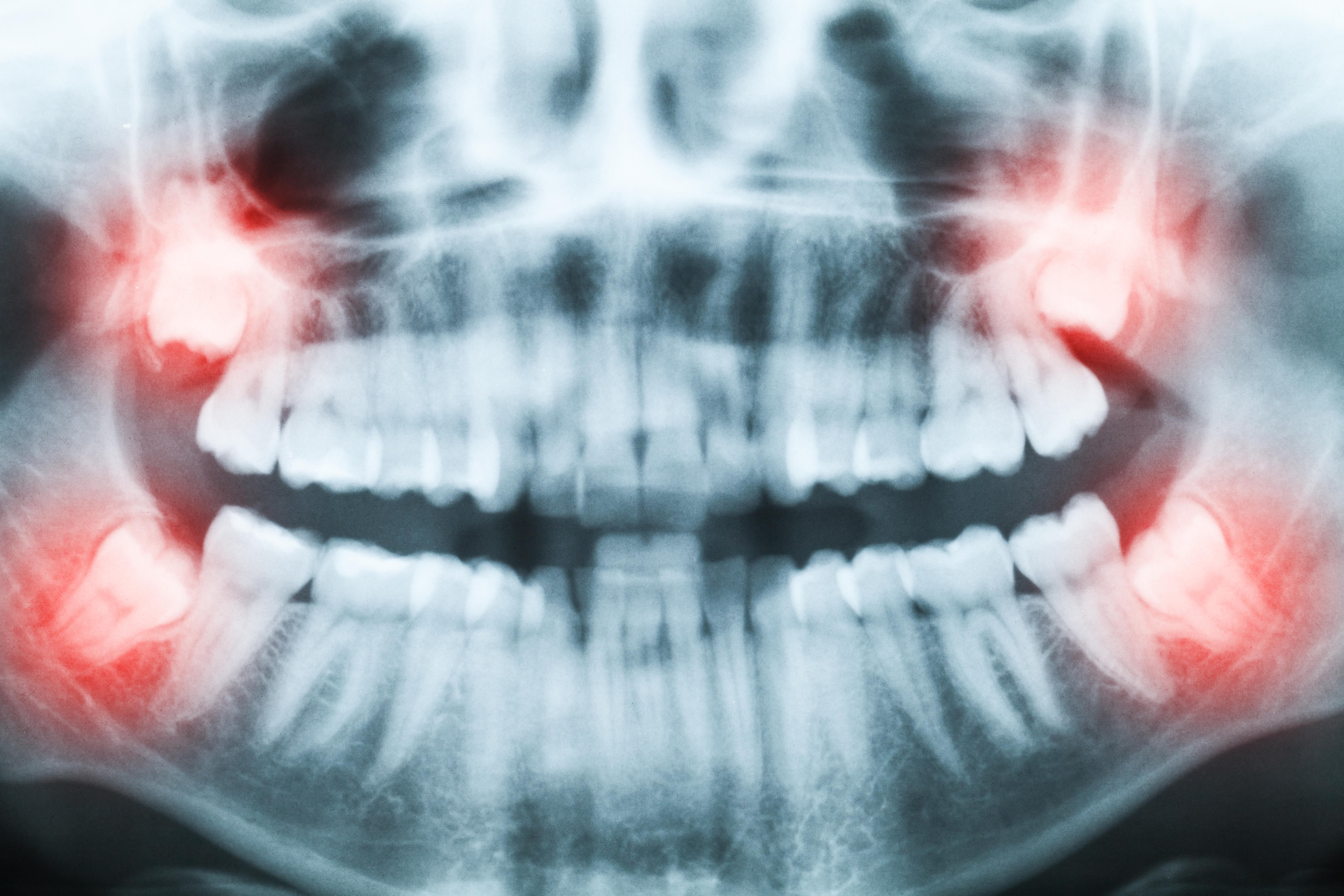 Wisdom Teeth Removal | Tooth Extraction Cost & Recovery Info