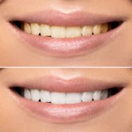 Teeth whitening hydrogen peroxide risks