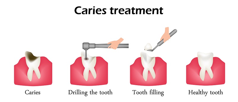 step-by-step dental filling procedure